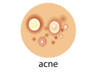 acne